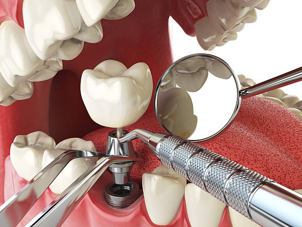 Best Emergency Treatment for Dental Infections or Abscesses in Millcreek, UT